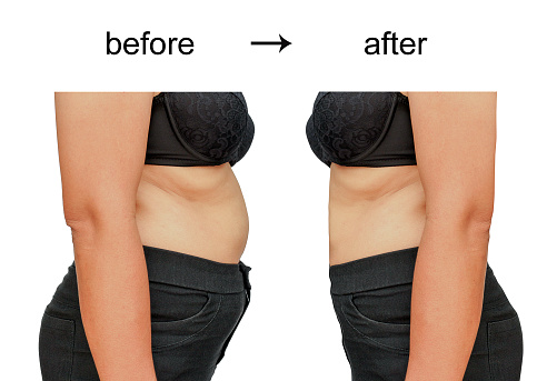 Am I a Good Candidate for Liposuction? - PORT CITY PLASTIC SURGERY