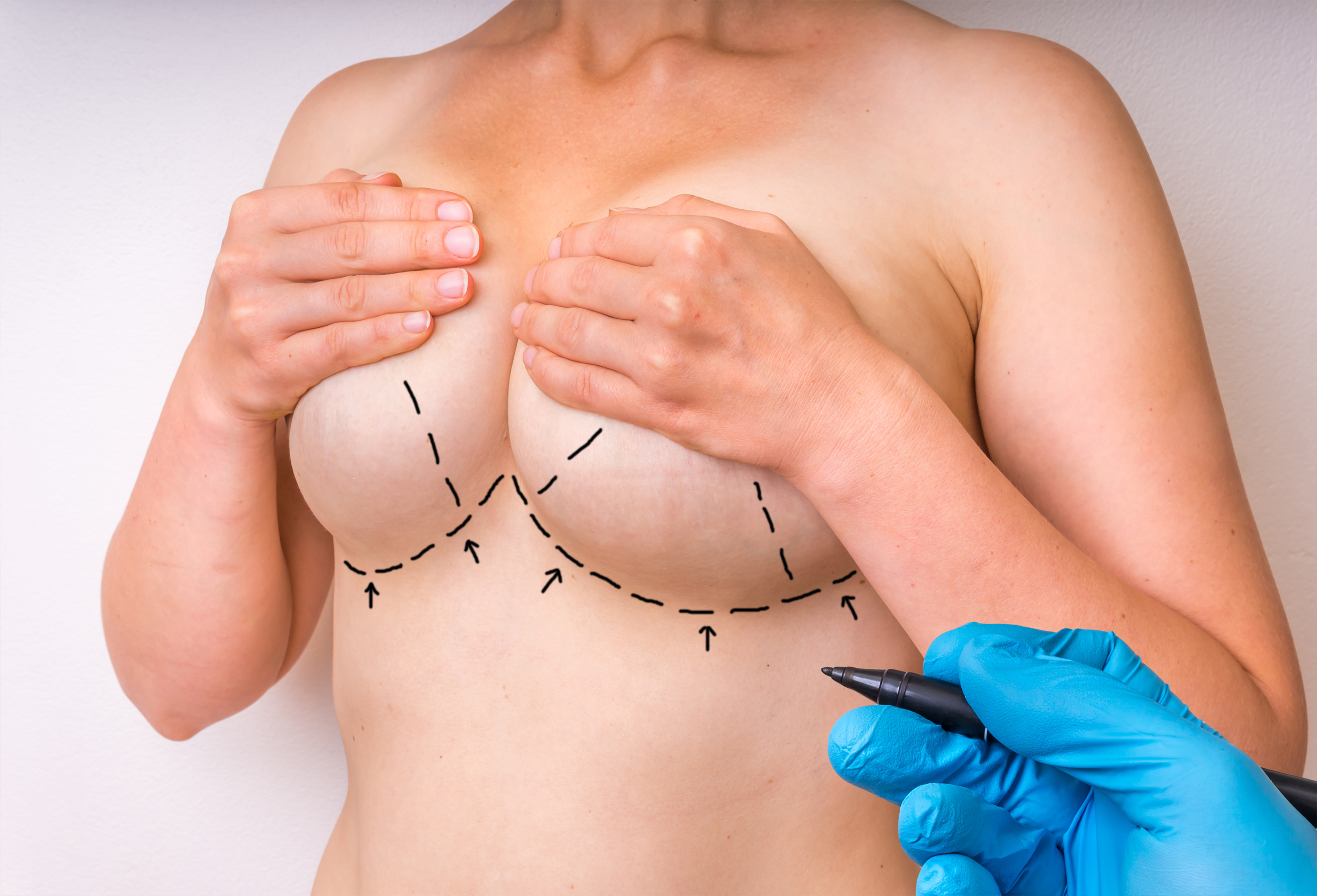 Breast Lift  The Plastic Surgery Clinic of Jackson